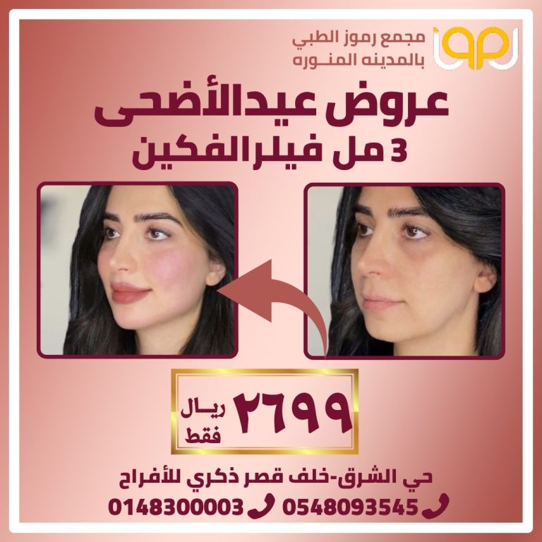 3 مل فيللر الفكين