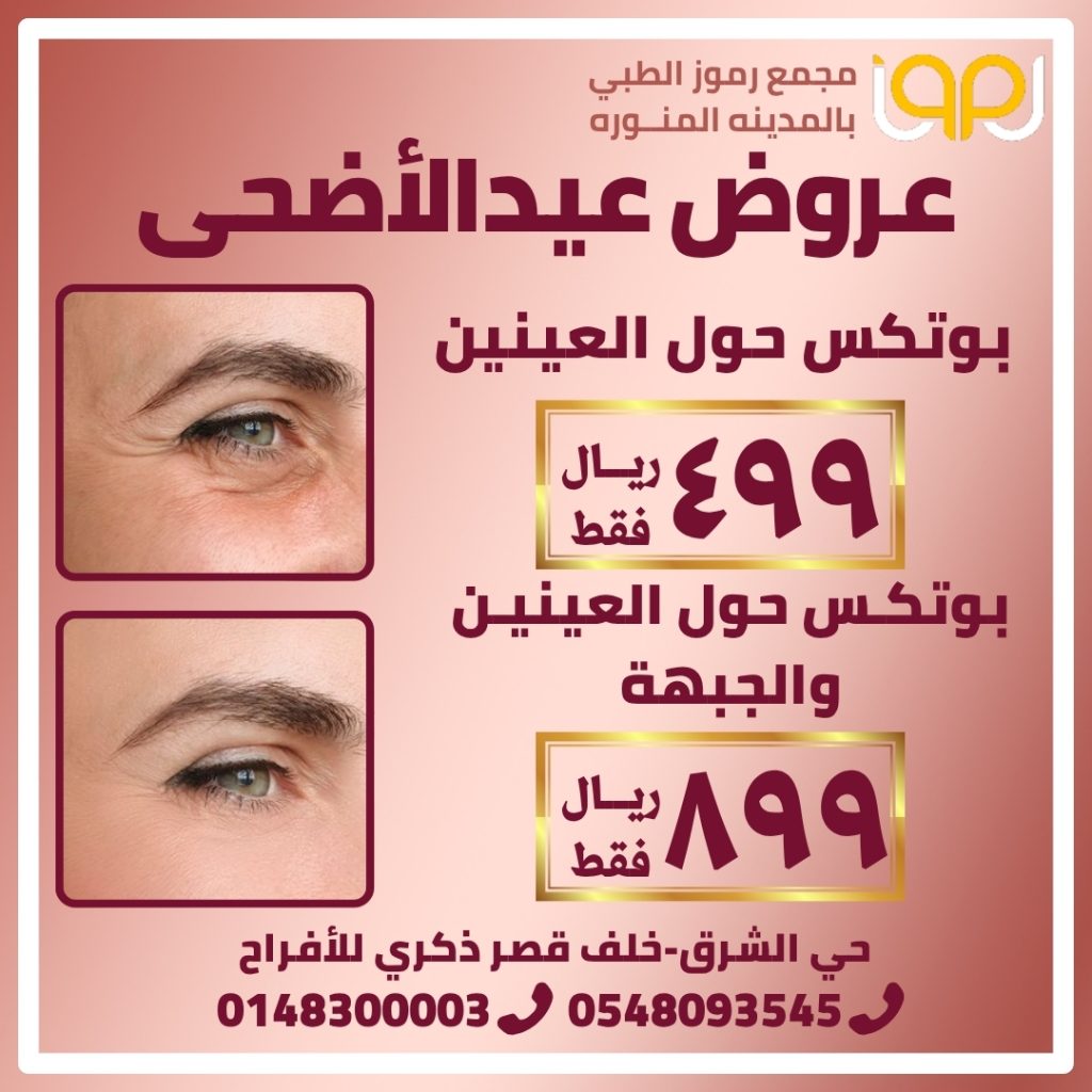 بوتكس حول العينين