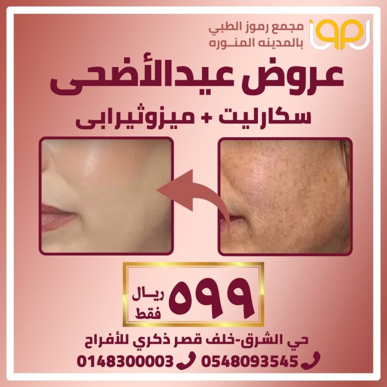 سكارليت مع ميزو ثيرابي